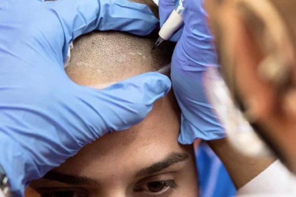 Hairline pigmentatie masterclass